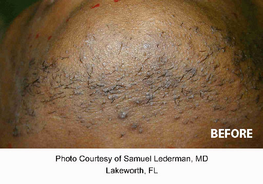 Laser Hair Removal Pensacola FL Panhandle Medical Aesthetics